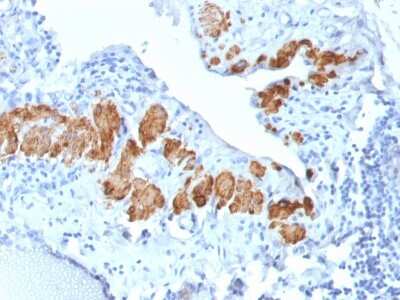 Immunohistochemistry-Paraffin: Myosin heavy chain 11 Antibody (MYH11/2303R) - Azide and BSA Free [NBP3-08486] - Formalin-fixed, paraffin-embedded human Breast Carcinoma stained with Myosin heavy chain 11 Recombinant Rabbit Monoclonal Antibody (MYH11/2303R).