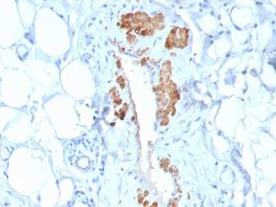 Immunohistochemistry-Paraffin: Myosin heavy chain 11 Antibody (MYH11/2303R) - Azide and BSA Free [NBP3-08486] - Formalin-fixed, paraffin-embedded human Breast Carcinoma stained with Myosin heavy chain 11 Recombinant Rabbit Monoclonal Antibody (MYH11/2303R).