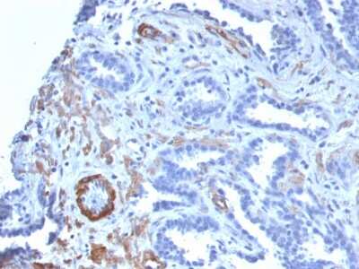 Immunohistochemistry-Paraffin: Myosin heavy chain 11 Antibody (MYH11/2303R) - Azide and BSA Free [NBP3-08486] - Formalin-fixed, paraffin-embedded human Prostate Carcinoma stained with Myosin heavy chain 11 Recombinant Rabbit Monoclonal Antibody (MYH11/2303R).