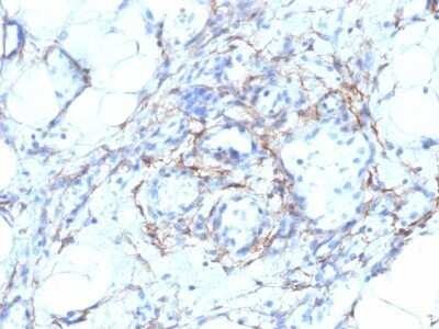 Immunohistochemistry-Paraffin: Myosin heavy chain 11 Antibody (MYH11/923 + SMMS-1) - Azide and BSA Free [NBP2-47901] - Human Angiosarcoma stained with SM-MHC Monoclonal Antibody (MYH11/923 + SMMS-1).