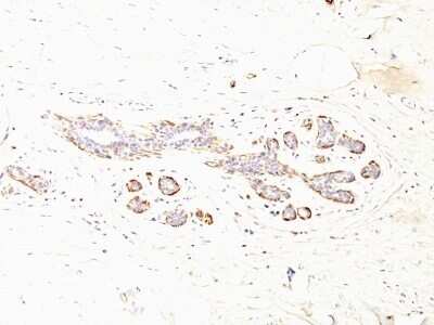 Immunohistochemistry-Paraffin: Myosin heavy chain 11 Antibody (MYH11/923 + SMMS-1) - Azide and BSA Free [NBP2-47901] - Human Breast Carcinoma stained with SM-MHC Monoclonal Antibody (MYH11/923 + SMMS-1).