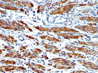 Immunohistochemistry-Paraffin: Myosin heavy chain 11 Antibody (MYH11/923 + SMMS-1) - IHC-Prediluted [NBP2-48150] - Human Leiomyosarcoma stained with SM-MHC Monoclonal Antibody (MYH11/923 + SMMS-1).