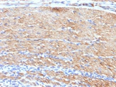 Immunohistochemistry-Paraffin: Myosin heavy chain 11 Antibody (MYH11/923 + SMMS-1) - IHC-Prediluted [NBP2-48150] - Human Colon Carcinoma stained with SM-MHC MAb (MYH11/923 + SMMS-1).