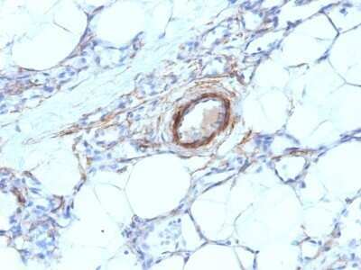 Immunohistochemistry-Paraffin: Myosin heavy chain 11 Antibody (MYH11/923) - Azide and BSA Free [NBP2-47900] - Human Angiosarcoma stained with SM-MHC Monoclonal Antibody (MYH11/923).