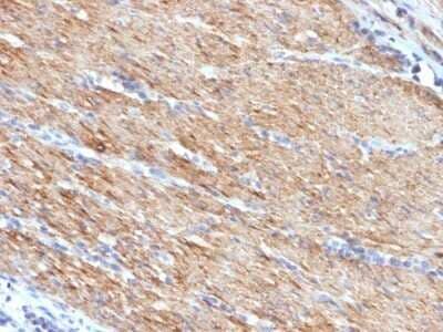 Immunohistochemistry-Paraffin: Myosin heavy chain 11 Antibody (MYH11/923) - Azide and BSA Free [NBP2-47900] - Human Colon Carcinoma stained with SM-MHC Monoclonal Antibody (MYH11/923).