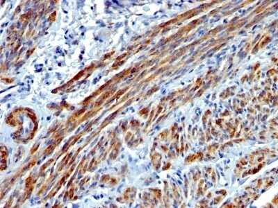 Immunohistochemistry-Paraffin: Myosin heavy chain 11 Antibody (MYH11/923) - Azide and BSA Free [NBP2-47900] - Human Leiomyosarcoma stained with SM-MHC Monoclonal Antibody (MYH11/923).