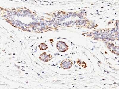 Immunohistochemistry-Paraffin: Myosin heavy chain 11 Antibody (MYH11/923) - Azide and BSA Free [NBP2-47900] - Human Breast Carcinoma stained with SM-MHC Monoclonal Antibody (MYH11/923).