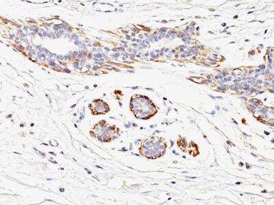 Immunohistochemistry-Paraffin: Myosin heavy chain 11 Antibody (MYH11/923) - IHC-Prediluted [NBP2-48149] - Human Breast Carcinoma stained with SM-MHC Mouse Monoclonal Antibody (MYH11/923).