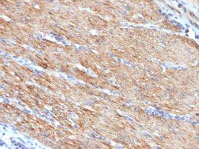 Immunohistochemistry-Paraffin: Myosin heavy chain 11 Antibody (MYH11/923) - IHC-Prediluted [NBP2-48149] - Human Colon Carcinoma stained with SM-MHC Mouse Monoclonal Antibody (MYH11/923).