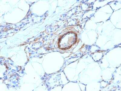 Immunohistochemistry-Paraffin: Myosin heavy chain 11 Antibody (MYH11/923) - IHC-Prediluted [NBP2-48149] - Human Angiosarcoma stained with SM-MHC Mouse Monoclonal Antibody (MYH11/923).