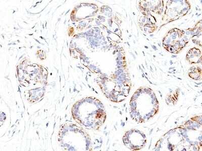 Immunohistochemistry-Paraffin: Myosin heavy chain 11 Antibody (SMMS-1) - Azide and BSA Free [NBP2-47898] - Human Breast Carcinoma stained with SM-MHC Monoclonal Antibody (SMMS-1).
