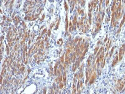 Immunohistochemistry-Paraffin: Myosin heavy chain 11 Antibody (SMMS-1) - Azide and BSA Free [NBP2-47898] - Human Leiomyosarcoma stained with SM-MHC Monoclonal Antibody (SMMS-1).