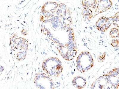 Immunohistochemistry-Paraffin: Myosin heavy chain 11 Antibody (SMMS-1) - IHC-Prediluted [NBP2-48443] - Formalin-fixed, paraffin-embedded human Breast Carcinoma stained with SM-MHC Monoclonal Antibody (SMMS-1).