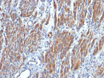 Immunohistochemistry-Paraffin: Myosin heavy chain 11 Antibody (SMMS-1) - IHC-Prediluted [NBP2-48443] - Formalin-fixed, paraffin-embedded human Leiomyosarcoma stained with SM-MHC Monoclonal Antibody (SMMS-1).