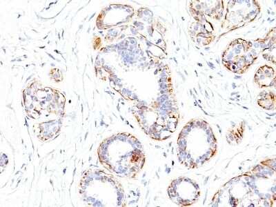 Immunohistochemistry-Paraffin: Myosin heavy chain 11 Antibody (SMMS-1) [NBP2-44530] - Human Breast Carcinoma stained with SM-MHC Monoclonal Antibody (SMMS-1).