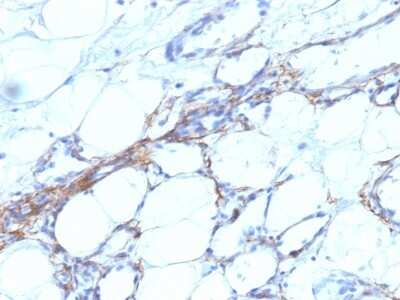 Immunohistochemistry-Paraffin: Myosin heavy chain 11 Antibody (SPM201) [NBP2-44531] - Human Angiosarcoma stained with SM-MHC Monoclonal Antibody (SPM201).