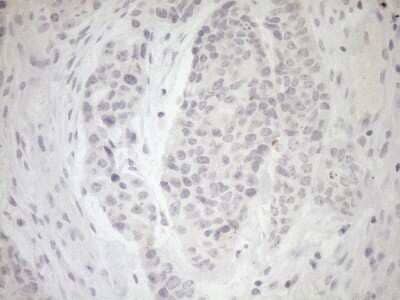 Immunohistochemistry: Myozenin 1 Antibody (4C2) [NBP2-46071] - Analysis of Adenocarcinoma of Human endometrium tissue. (Heat-induced epitope retrieval by 1mM EDTA in 10mM Tris buffer (pH8.5) at 120C for 3 min)