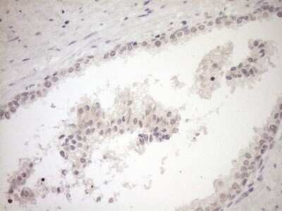 Immunohistochemistry: Myozenin 1 Antibody (4C2) [NBP2-46071] - Analysis of Carcinoma of Human prostate tissue. (Heat-induced epitope retrieval by 1mM EDTA in 10mM Tris buffer (pH8.5) at 120C for 3 min)