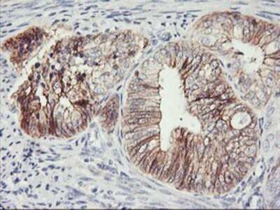 Immunohistochemistry: N-Cadherin Antibody (OTI2G7) - Azide and BSA Free [NBP2-72891] - Staining of paraffin-embedded Adenocarcinoma of Human endometrium tissue using anti-N Cadherin mouse monoclonal antibody.