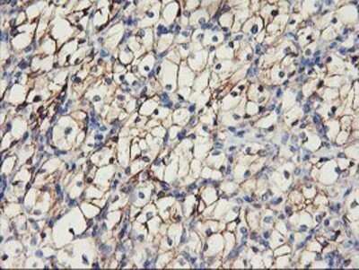 Immunohistochemistry: N-Cadherin Antibody (OTI2G7) - Azide and BSA Free [NBP2-72891] - Staining of paraffin-embedded Carcinoma of Human kidney tissue using anti-N Cadherin mouse monoclonal antibody.