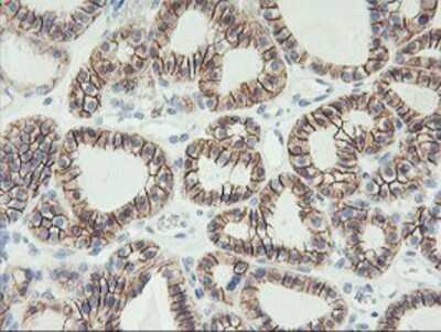 Immunohistochemistry: N-Cadherin Antibody (OTI2G7) - Azide and BSA Free [NBP2-72891] - Staining of paraffin-embedded Carcinoma of Human thyroid tissue using anti-N Cadherin mouse monoclonal antibody.