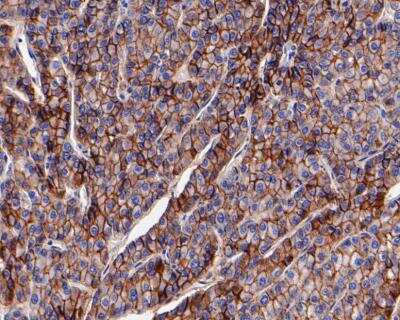 Immunohistochemistry-Paraffin: N-Cadherin Antibody (SY02-46) [NBP2-67431] - Immunohistochemical analysis of paraffin-embedded human liver cancer tissue using anti-N Cadherin antibody. Counter stained with hematoxylin.