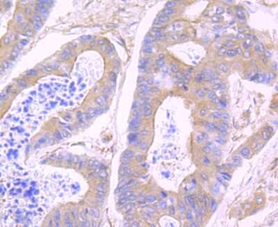 Immunohistochemistry-Paraffin: N-WASP Antibody (JU07-31) [NBP2-75599] - Analysis of paraffin-embedded human colon cancer tissue using anti-WASL antibody. Counter stained with hematoxylin.