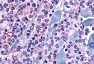 Immunohistochemistry-Paraffin: NANP Antibody [NB110-39024] - Analysis of anti-NANP antibody with human breast, carcinoma at concentration 8 ug/ml.