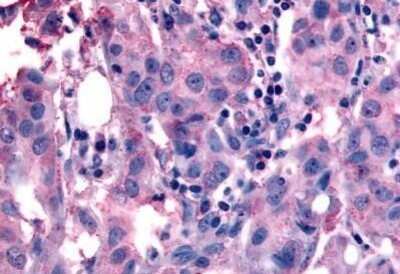 Immunohistochemistry-Paraffin: NANP Antibody [NB110-39025] - Analysis of anti-NANP antibody with human breast, carcinoma at concentration 15 ug/ml.