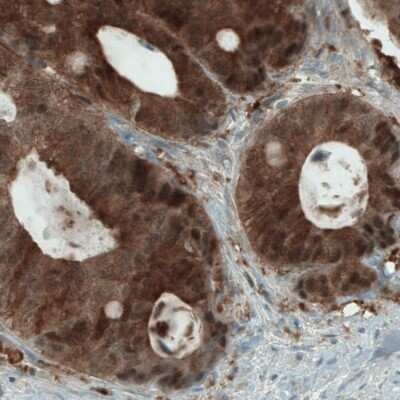 Immunohistochemistry-Paraffin: NAPRT1 Antibody (CL0665) [NBP2-52954] - Staining of human colorectal cancer shows strong immunoreactivity in tumor cells.