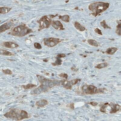 Immunohistochemistry-Paraffin: NAPRT1 Antibody (CL0665) [NBP2-52954] - Staining of human breast cancer shows positivity in tumor cells.