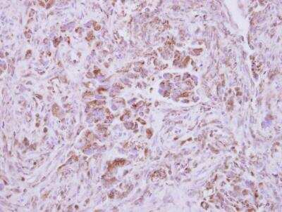 Immunohistochemistry-Paraffin: NAPRT1 Antibody [NBP2-19471] - Immunohistochemical analysis of paraffin-embedded Lung ca, using antibody at 1:500 dilution.