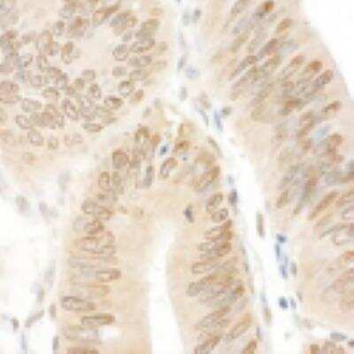 Immunohistochemistry-Paraffin: NARG1 Antibody [NBP1-21387] - Colon carcinoma used at a dilution of 1:80.