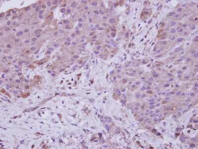 Immunohistochemistry-Paraffin: NARG1 Antibody [NBP2-19478] - Immunohistochemical analysis of paraffin-embedded Breast ca, using antibody at 1:250 dilution.