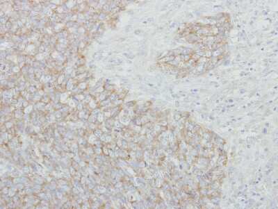 Immunohistochemistry-Paraffin: NARS Antibody [NBP1-31896] - Paraffin-embedded Breast ca, using antibody at 1:250 dilution.