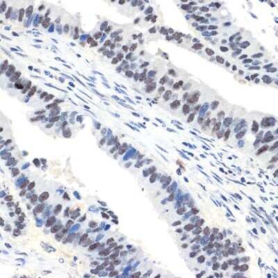 Immunohistochemistry-Paraffin: NAT10 Antibody (5Z3E5) [NBP3-15742] - Human colon carcinoma using NAT10 Rabbit mAb (NBP3-15742) at dilution of 1:100 (40x lens).Perform microwave antigen retrieval with 10 mM Tris/EDTA buffer pH 9.0 before commencing with IHC staining protocol.