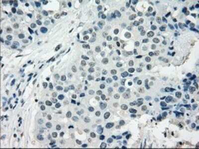 Immunohistochemistry: NAT8 Antibody (OTI5A8) - Azide and BSA Free [NBP2-72878] - Staining of paraffin-embedded Adenocarcinoma of breast tissue using anti-NAT8 mouse monoclonal antibody.