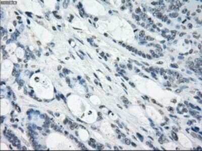 Immunohistochemistry: NAT8 Antibody (OTI5A8) - Azide and BSA Free [NBP2-72878] - Staining of paraffin-embedded Adenocarcinoma of colon tissue using anti-NAT8 mouse monoclonal antibody.