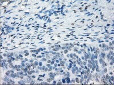 Immunohistochemistry: NAT8 Antibody (OTI5A8) - Azide and BSA Free [NBP2-72878] - Staining of paraffin-embedded Adenocarcinoma of ovary tissue using anti-NAT8mouse monoclonal antibody.