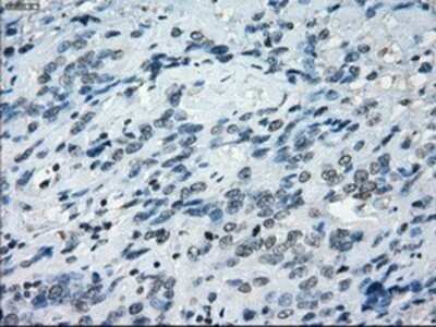 Immunohistochemistry: NAT8 Antibody (OTI5A8) - Azide and BSA Free [NBP2-72878] - Staining of paraffin-embedded Carcinoma of bladder tissue using anti-NAT8 mouse monoclonal antibody.