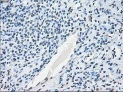 Immunohistochemistry: NAT8 Antibody (OTI5A8) - Azide and BSA Free [NBP2-72878] - Staining of paraffin-embedded Carcinoma of thyroid tissue using anti-NAT8 mouse monoclonal antibody.