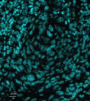 Imaging Mass Cytometry: NCAM-1/CD56 Antibody (123A8 (same as 56C04)) - Azide and BSA Free [NBP2-34518] - Image of human cutaneous squamous cell carcinoma tumor stained with Anti-NCAM-1/CD56 Azide/BSA Free Antibody [123A8] (in red). IMC image submitted by a verified customer review.
