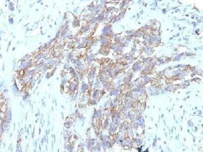 Immunohistochemistry-Paraffin: NCAM-1/CD56 Antibody (123C3.D5 + 123A8) - IHC-Prediluted [NBP2-44715] - Formalin-fixed, paraffin-embedded human Lung Carcinoma stained with CD56 Monoclonal Antibody (123C3.D5 + 123A8)