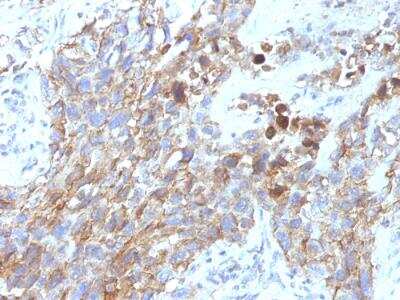 Immunohistochemistry-Paraffin: NCAM-1/CD56 Antibody (NCAM1/795) - IHC-Prediluted [NBP2-48193] - Formalin-fixed, paraffin-embedded human Lung Carcinoma stained with CD56 Mouse Monoclonal Antibody (NCAM1/795).