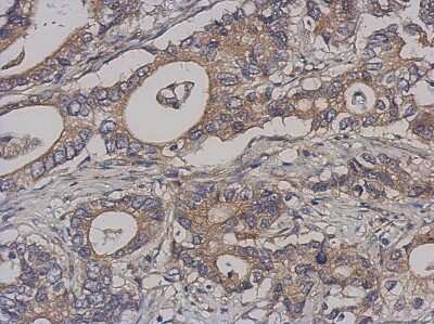 Immunohistochemistry-Paraffin: NCAPH Antibody [NBP1-32573] - Human gastric cancer, using BRRN1 antibody at 1:500 dilution.  Antigen Retrieval: Trilogy™ (EDTA based, pH 8.0) buffer, 15min.