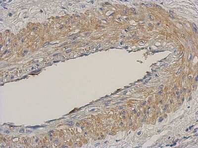 Immunohistochemistry-Paraffin: NCAPH Antibody [NBP2-19483] - Immunohistochemical analysis of paraffin-embedded Gastric ca, using antibody at 1:500 dilution.