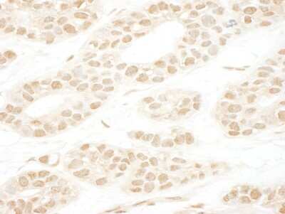 Immunohistochemistry: NCAPH2 Antibody [NBP1-28723] - Sample: FFPE section of human breast carcinoma. Antibody: Affinity purified rabbit anti-CAP-H2 used at a dilution of 1:1,000 (1ug/ml). Detection: DAB staining using Immunohistochemistry Accessory Kit.