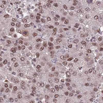Immunohistochemistry-Paraffin: NCBP1 Antibody [NBP2-33546] - Staining of liver cancer.