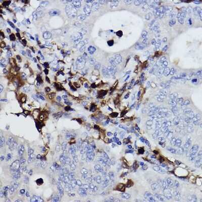 Immunohistochemistry-Paraffin: NCF4 Antibody (4L9Z4) [NBP3-15322] - Immunohistochemistry of paraffin-embedded human colon carcinoma using NCF4 Rabbit mAb (NBP3-15322) at dilution of 1:100 (40x lens).Perform high pressure antigen retrieval with 10 mM citrate buffer pH 6.0 before commencing with IHC staining protocol.