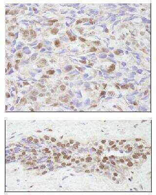 Immunohistochemistry: NCOA2 Antibody [NB100-1756] - Samples:  FFPE sections of human breast adenocarcinoma (upper image) and prostate adenocarcinoma (lower image).  Antibody: Affinity purified rabbit anti-SRC2 NB100-1756 used at a dilution of 1:100.  Detection:  DAB